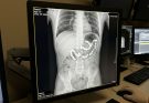 My 5-Year-Old Daughter Said “Fish Are Biting Me”—The X-Ray Found 36 Magnets in Her Stomach.
